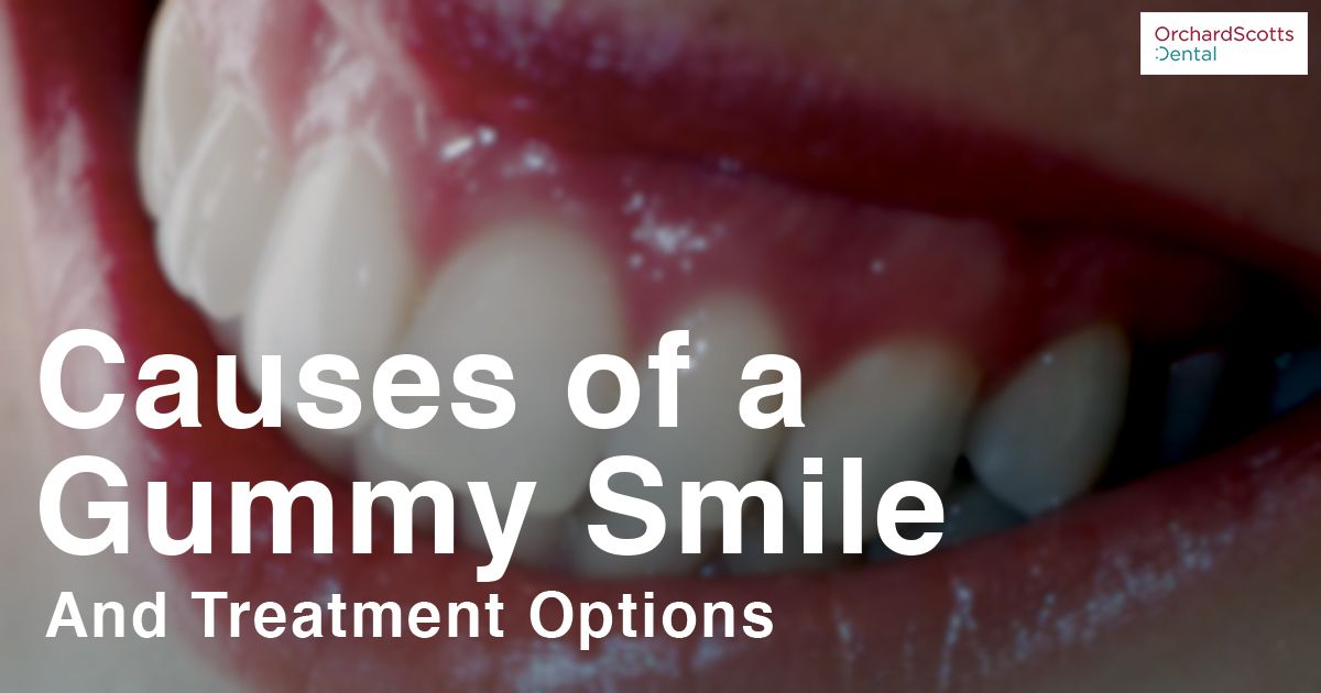 Causes of a Gummy Smile and Treatment Options