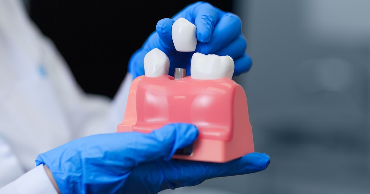 Essential Facts About Dental Implants