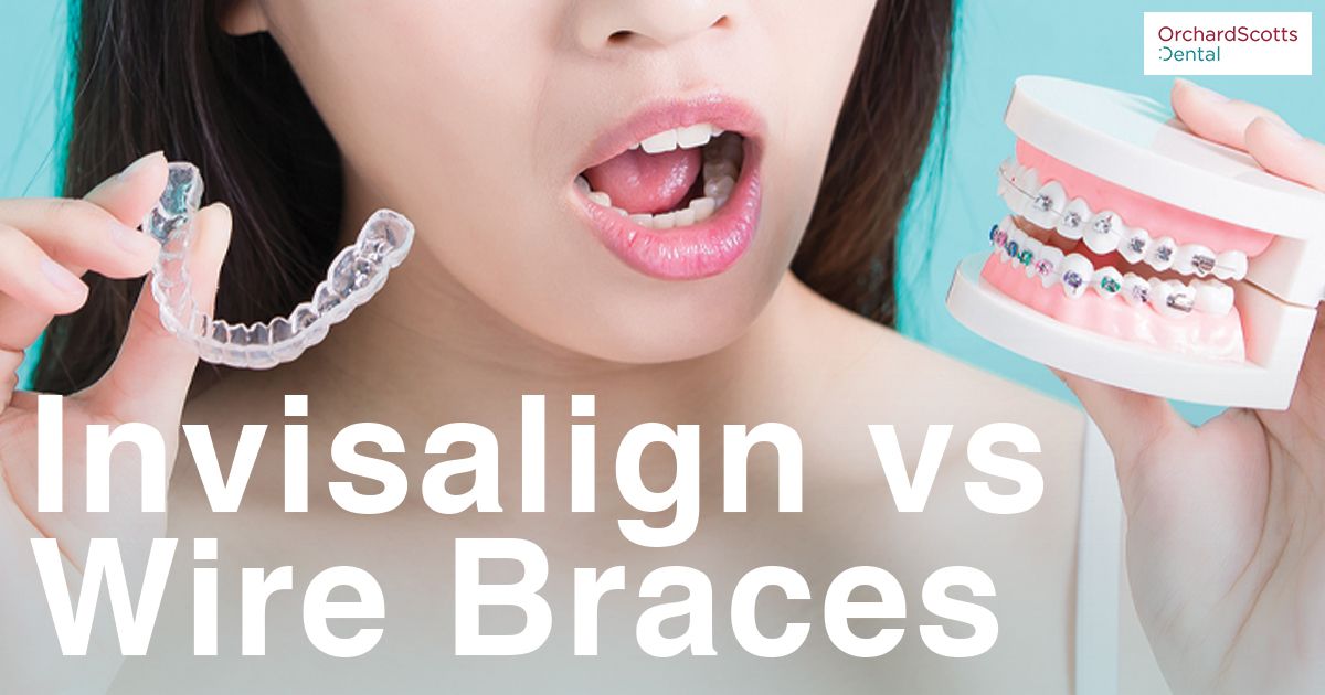 Invisalign vs Wire Braces