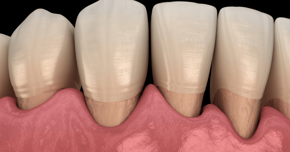 What Treatment is Better for Your Gum Recession?