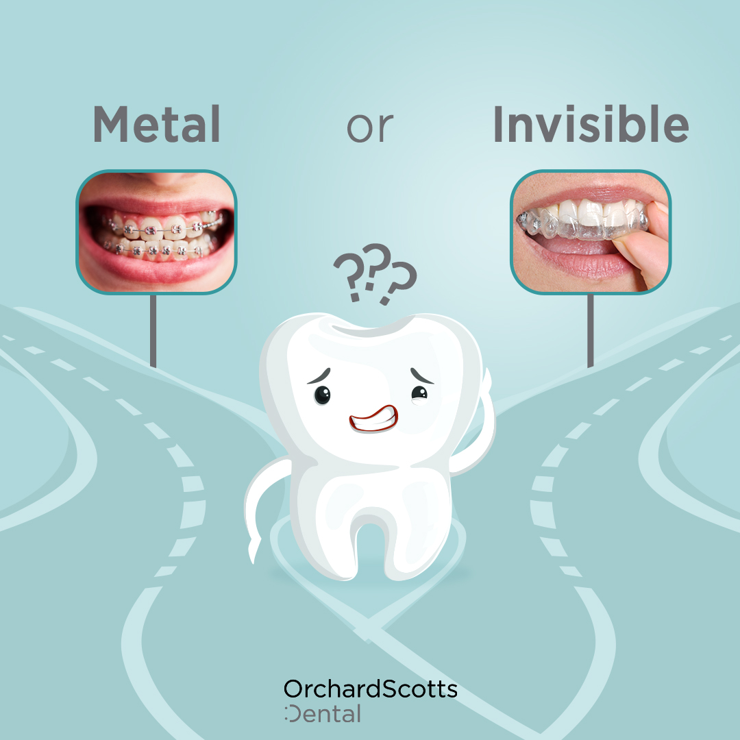 Veneers, Braces or Invisalign – Which is Best?