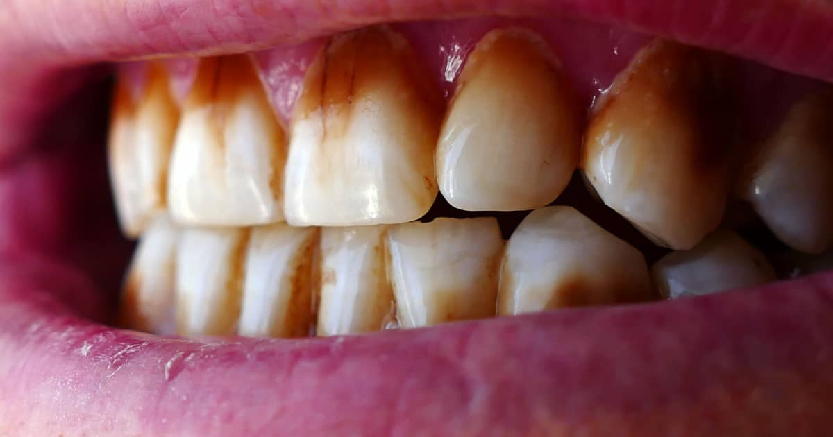 What To Do If Teeth Whitening Won’t Remove Stains On Teeth