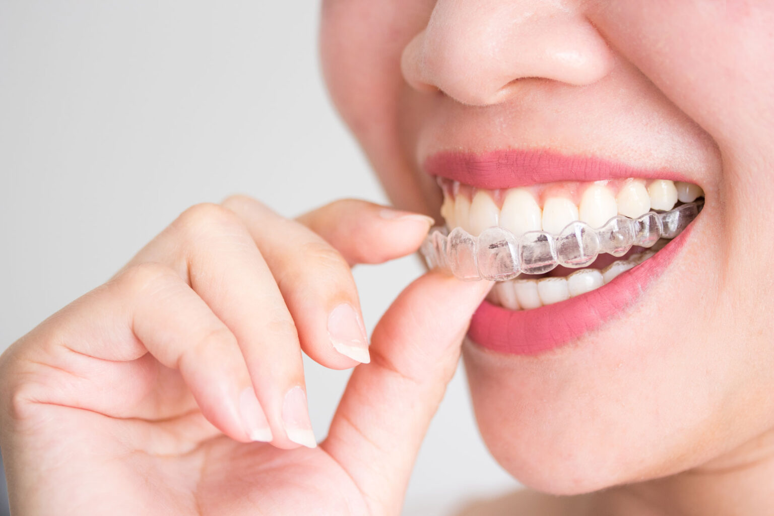 A-Guide-To-Clear-Aligners