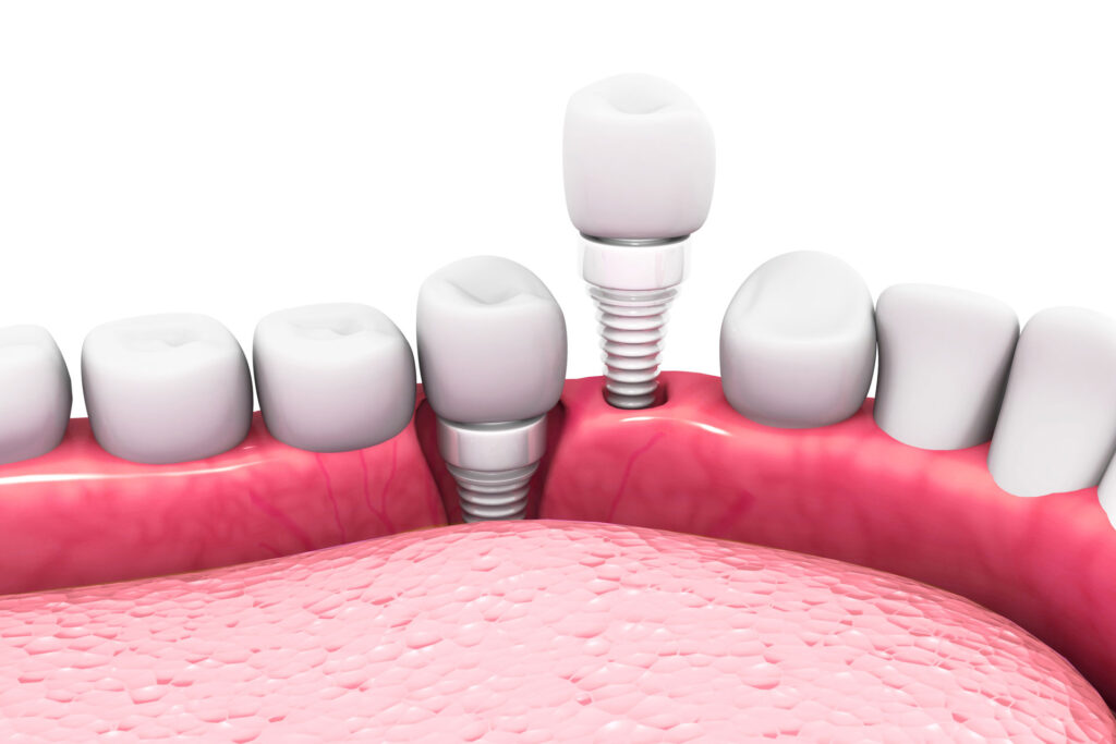 are ceramic dental implants worth the investment