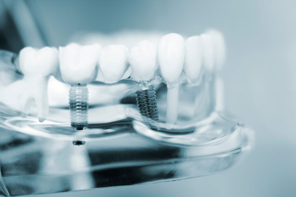 dental implants quality of life